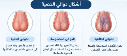 الفرق بين درجات دوالي الخصية